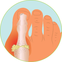 Knee Surgery - Gout